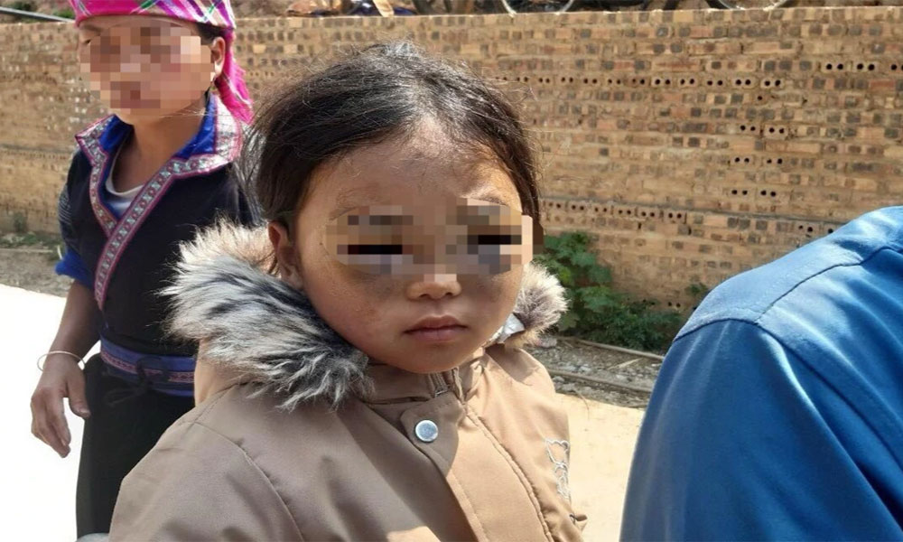 Xác minh vụ bé gái lớp 1 ở Yên Bái nghi bị cô giáo đánh